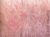 Dry Skin (Xerosis) – Adult