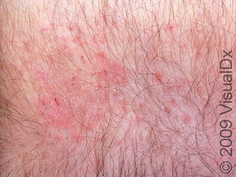This image displays a mild rash due to itching caused by dry skin.