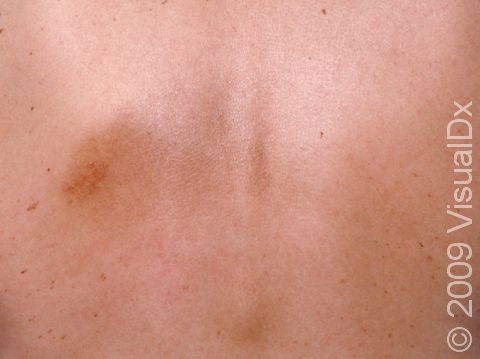 Just below the shoulder blade (scapula), a pigmented patch typical of notalgia paresthetica.