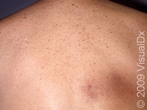 The brown, flat area underneath the right shoulder blade is caused by continual rubbing and scratching.
