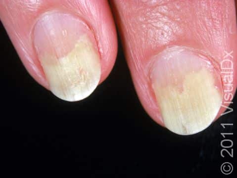 Nail Lifting (Onycholysis) Condition, Treatments and Pictures for Adults -  Skinsight