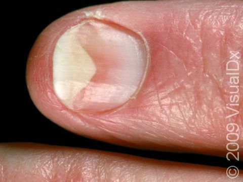 As displayed in this image, in onycholysis, the nail is lifted from the nail bed and appears white or yellow.