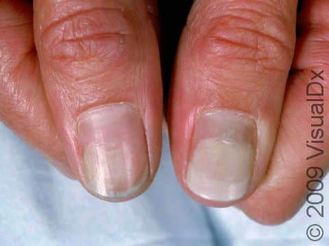 Brits tell of lifechanging allergies triggered by gel polish as  Government launches investigation  Daily Mail Online