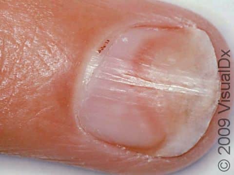 This image displays onycholysis (lifting of the nail) caused by psoriasis.