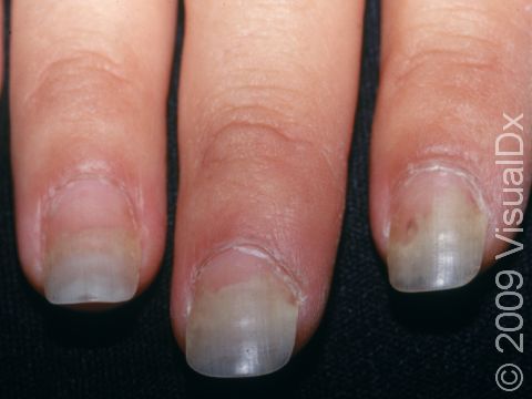 This image displays nails that have separated from the nail bed, caused by onycholysis.
