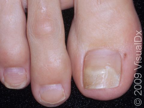 Medicinsk malpractice Mindful kradse Nail Lifting (Onycholysis) Condition, Treatments and Pictures for Adults -  Skinsight