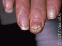 Nail Infection, Fungal (Onychomycosis) – Adult