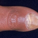 Common Nail Problems