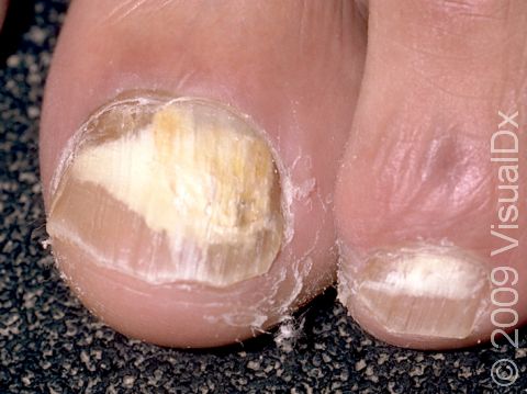 Aggregate more than 119 white superficial nail infection super hot