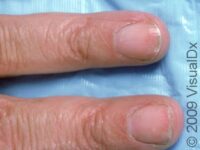 Nail Splitting (Onychoschizia) – Adult