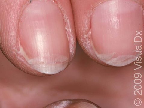 This image displays the plate-like splitting of the nail in onychoschizia.