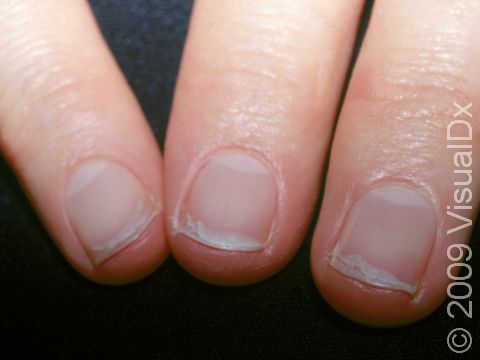 Dark lines in nails  MDedge Family Medicine