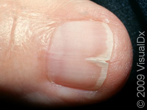 Onychoschizia means splitting of the fingernails, as displayed in this image.