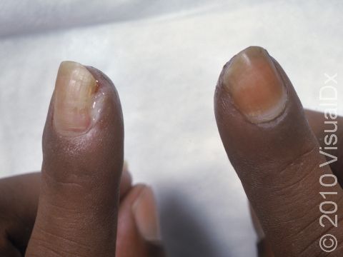 Aggregate 157+ trichophyton tonsurans nail infection latest