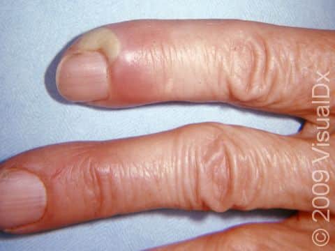 Share more than 129 swelling of the nail