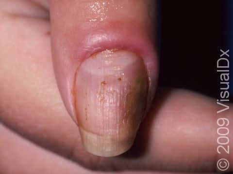 Typical to paronychia, the nail fold is swollen, red, and tender.