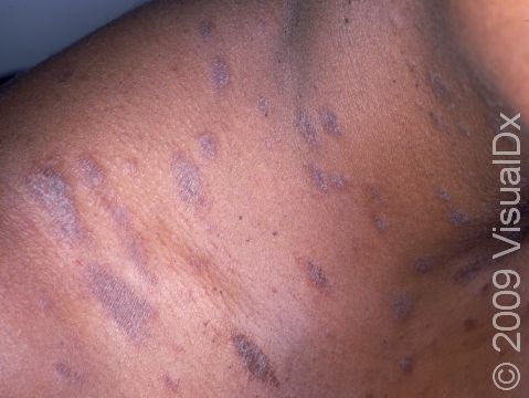 In people with darker skin, pityriasis rosea can have a deeper color, as displayed here.