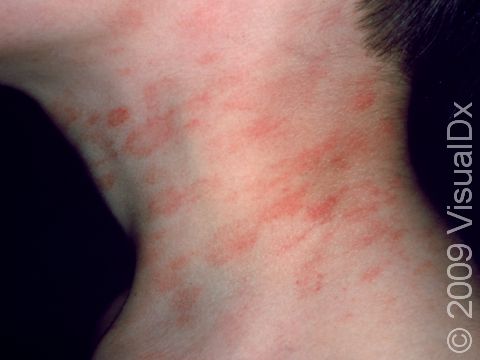 This image displays pityriasis rosea on the neck.
