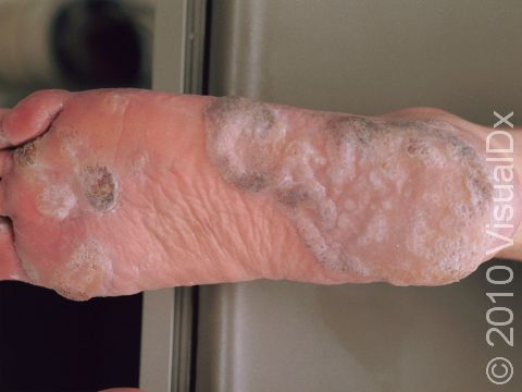 This image displays a severe case of plantar warts.