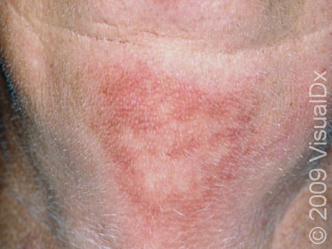 This image displays a flat, pink discoloration on the neck typical of chronic sun exposure.