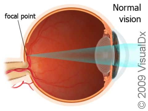 In the normal eye, the image of what is being viewed falls directly on the back of the eye (retina).