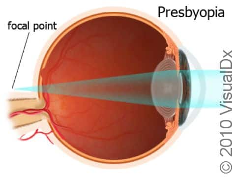 In an eye with presbyopia, the image of what is being viewed falls in back of the eye, necessitating glasses to focus the image directly on the back of the eye (retina).