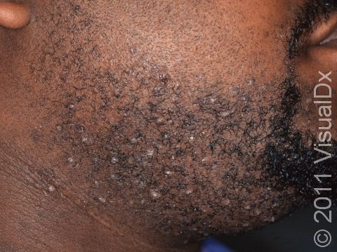 Severe pseudofolliculitis barbae can lead to small bumps and sometimes scarring, as seen here.