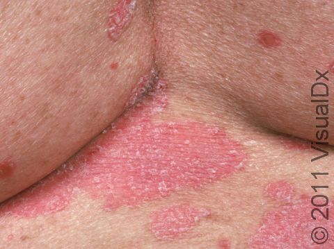 Psoriasis typically has bright red or pink circular, scaling patches, which may be seen anywhere on the body.