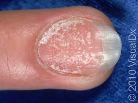 This image displays pits, roughness, and lifting of the tip of the nail tip typical of psoriasis of the nail.
