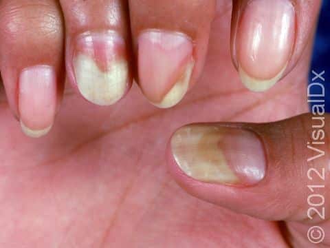 This image displays yellow, lifted nails from onycholysis, which is frequent in psoriasis.