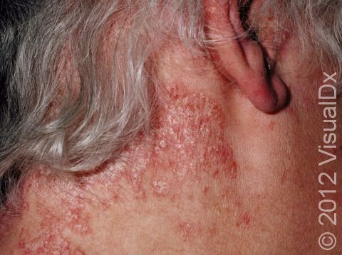 Psoriasis may involve large areas of scaling, such as on the neck and scalp.