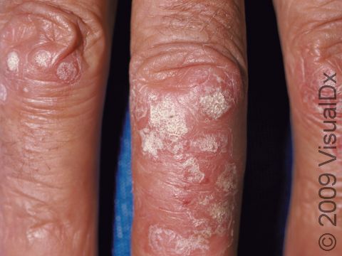 These small bumps and slightly elevated lesions have the typical white scale of psoriasis.