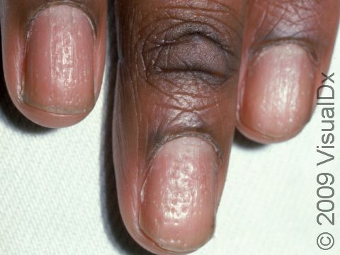 Numerous tiny nail pits are common in people with psoriasis.