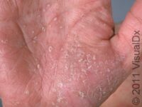 Chronic Itchy Skin Rashes in Adults