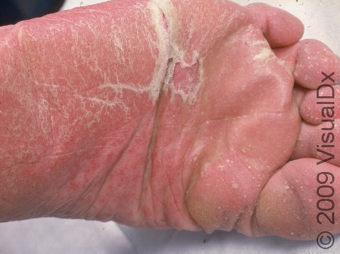 Pinkness and scaly skin can cover the soles when psoriasis is on the feet.