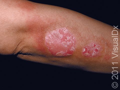 Psoriasis can have large, scaling, slightly elevated lesions. These lesions are usually found near or at the elbow as well as the forearm, knees, legs, scalp, buttocks, and genital areas.