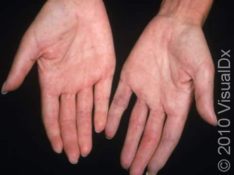This image displays the hands of a person with scleroderma and a severe case of Raynaud's disease.