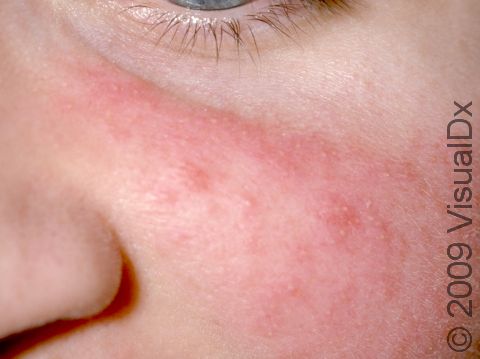 This image displays small pink bumps and pus-filled lesions on the cheeks typical of rosacea.