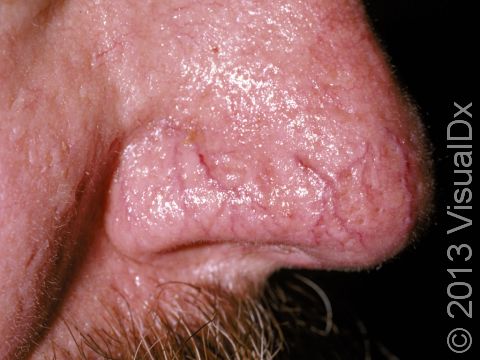 This image displays the dilated blood vessels that are typically seen in rosacea.
