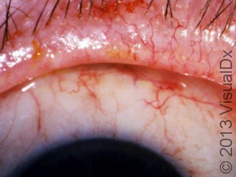 This image displays eyelids with small crusts caused by rosacea.
