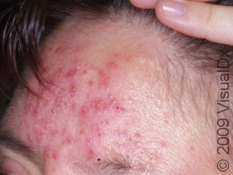 The central forehead is often affected in severe rosacea with multiple pimple-like bumps.