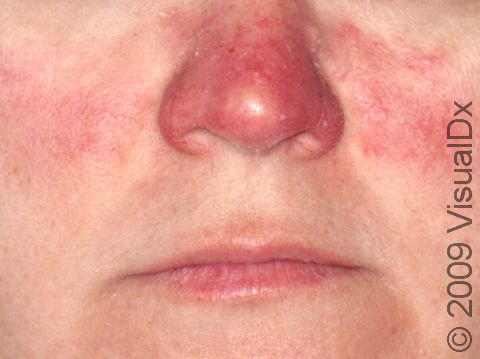 The nose can be bright red in people with rosacea.