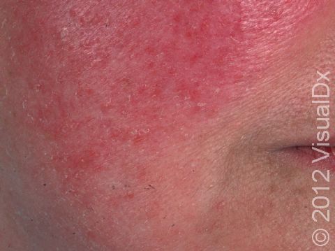 This image displays broad areas of redness on the cheeks typical of rosacea.