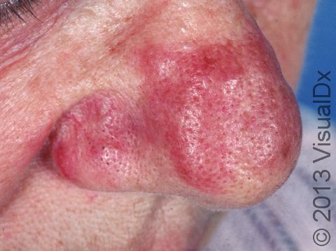 This image displays the redness and thickening of the nose typical of rosacea.