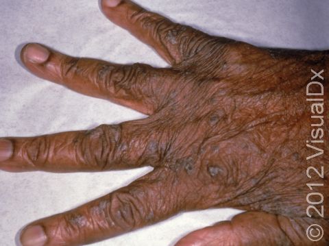 The red bumps typical of scabies are harder to see on the back of the fingers and hands in people with darker skin colors, as displayed in this image.