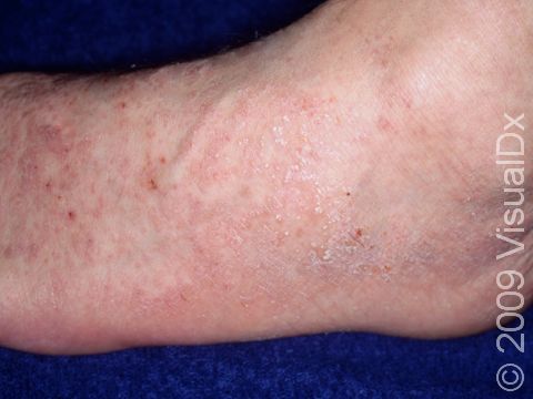 While scabies is usually seen as irregular red, scaling, scratched patches anywhere on the body, there are usually some spots noted on the hands or feet.