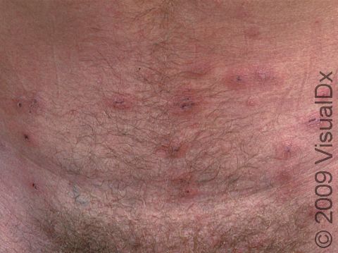 This image displays skin lesions typical of scabies.