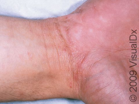 This image displays a fine, scaly line due to a subtle scabies mite burrow.