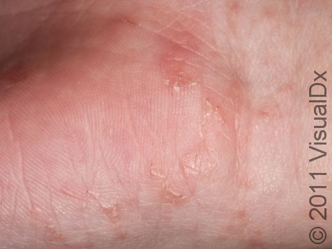 The scabies mite is tiny, almost impossible to see without magnification. This close-up photo shows multiple burrows with the faint hint of the mite at the end of its superficial skin tunnel.