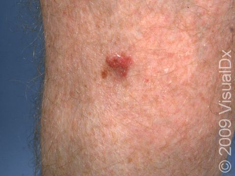 This red lesion, specifically called a plaque, on the leg is typical of a superficial squamous cell carcinoma.